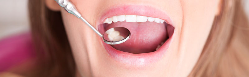 Causes and Signs of Damaged Fillings - Bismarck, ND