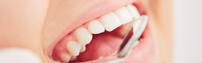 Causes and Signs of Damaged Fillings - Bismarck, ND