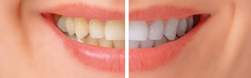 Teeth Whitening Bismarck ND