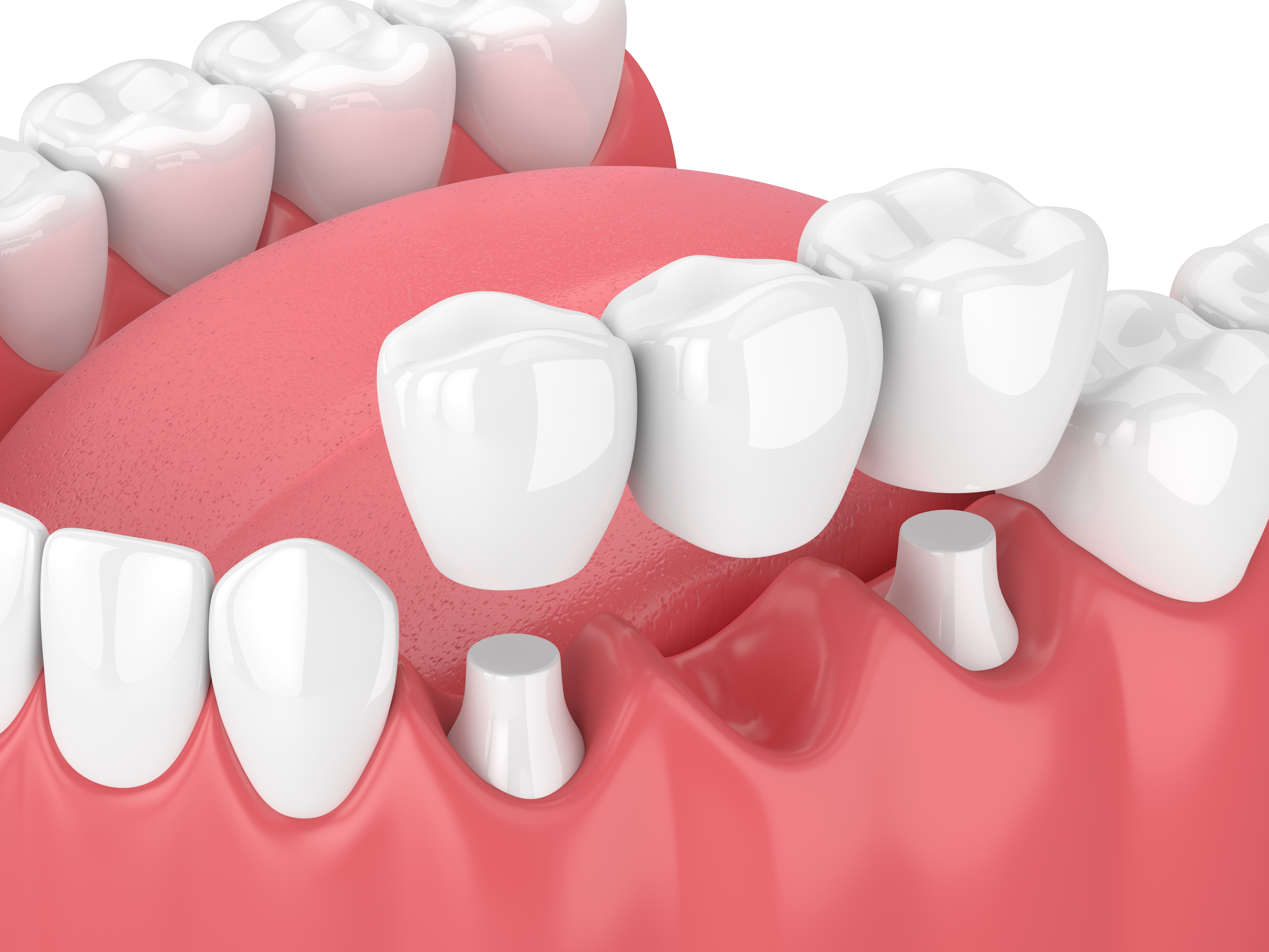dental implants | Bismarck, ND